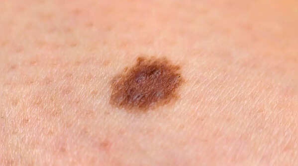 Irregular pigment spread around a mole.