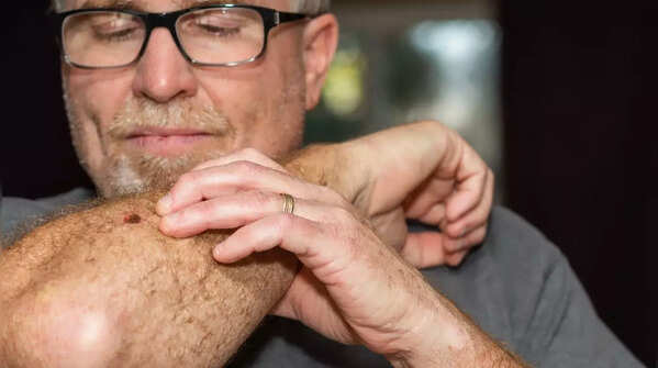Examining moles for potential skin cancer.