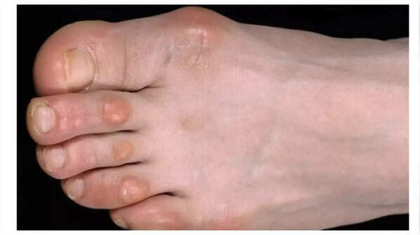 Painful lumps on fingers or toes as a sign of heart problems