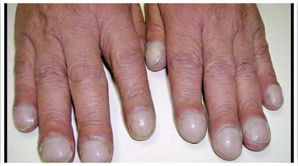 Changes in nail shape indicating potential heart or lung issues