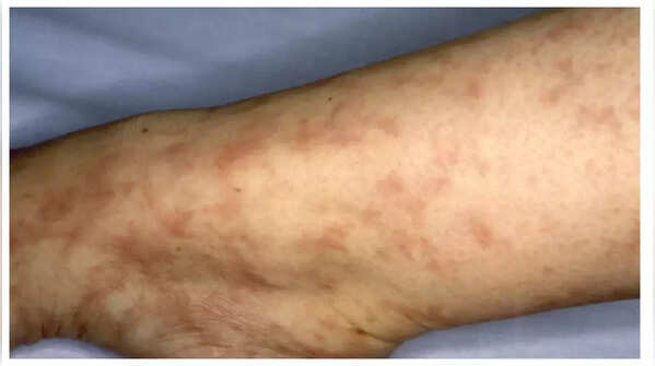 Net-like purple skin pattern suggesting cholesterol issues