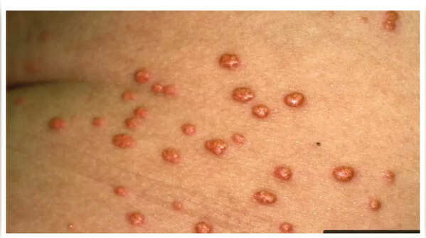 Yellowish-orange skin bumps related to high cholesterol