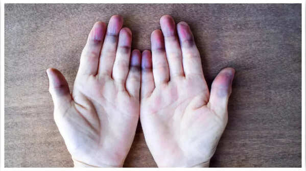 Blue or purple skin discoloration, a possible heart disease symptom