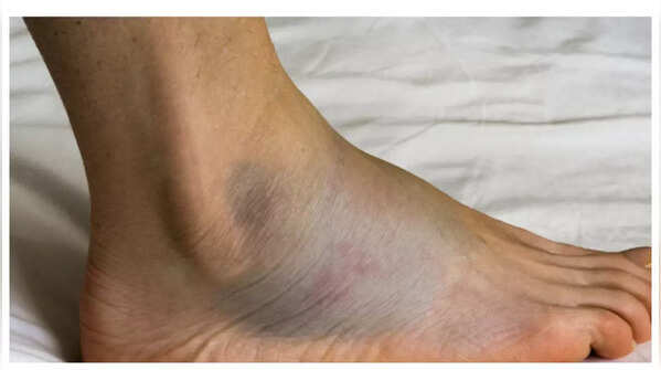 Swollen feet and legs indicating potential heart issues